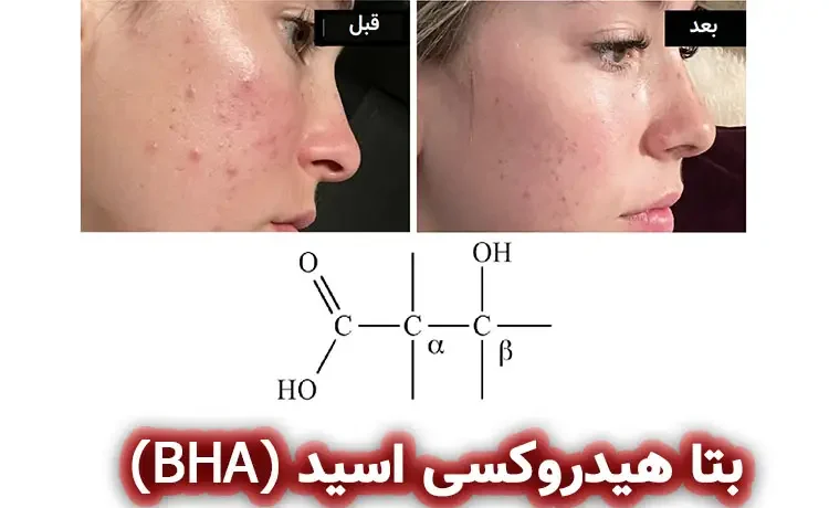بتا هیدروکسی اسید (Beta hydroxy acid, BHA)