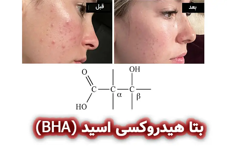 بتا هیدروکسی اسید (Beta hydroxy acid, BHA)