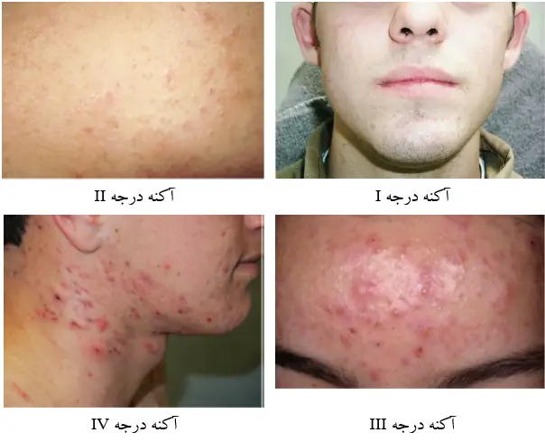 درجات مختلف انواع آکنه