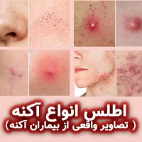 اطلس انواع آکنه