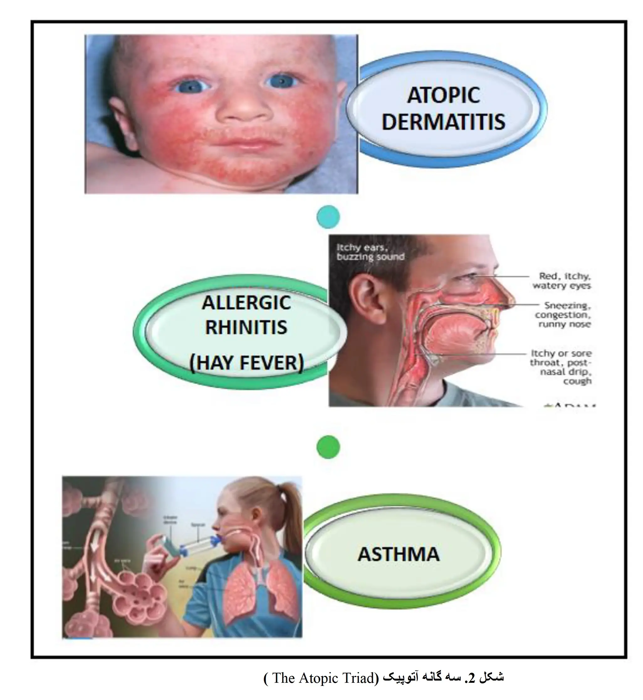 The Atopic Triad