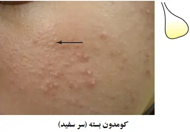 کومدون بسته چیست؟