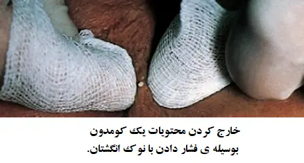 خارج کردن محتویات کومدون ها