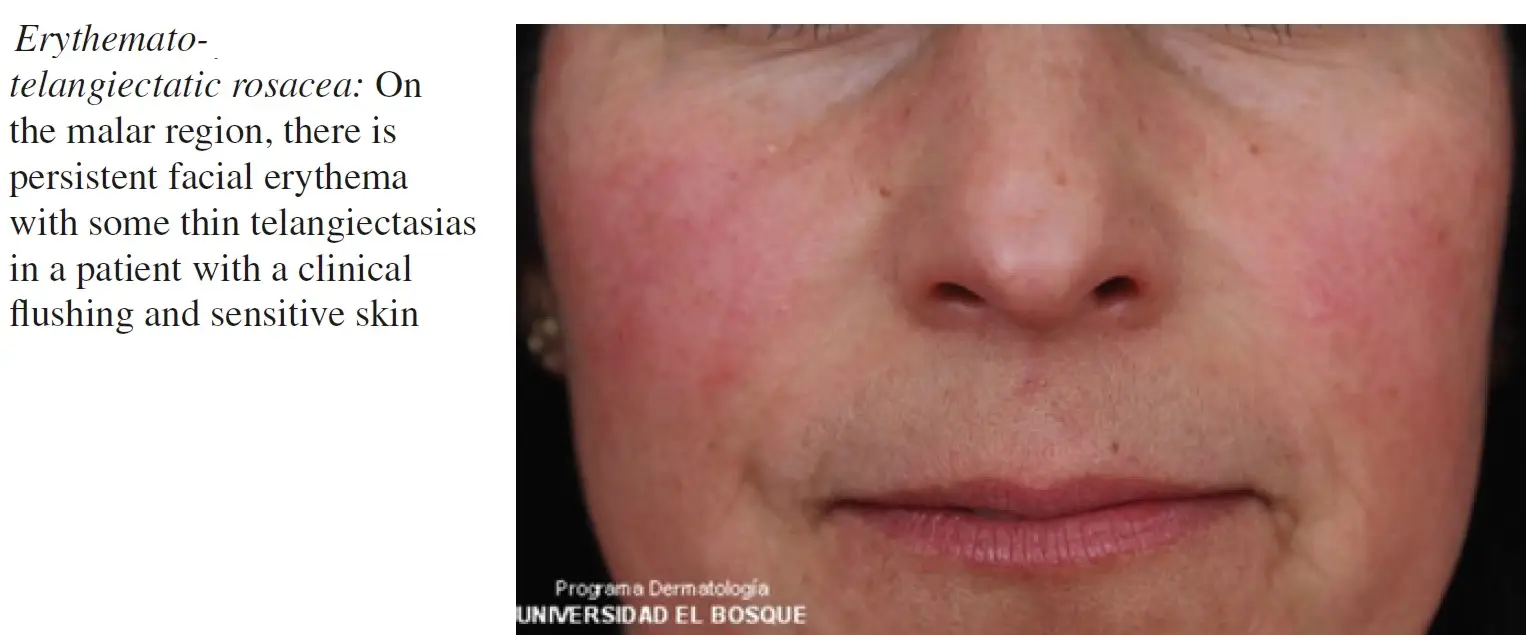 erythematotelangiectatic rosacea