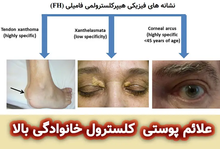 علائم پوستی و مویی کلسترول بالا