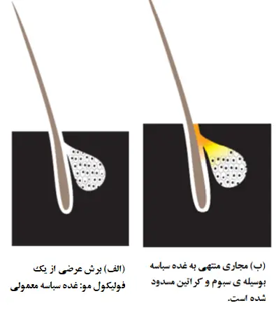 نمایش غدد سباسه