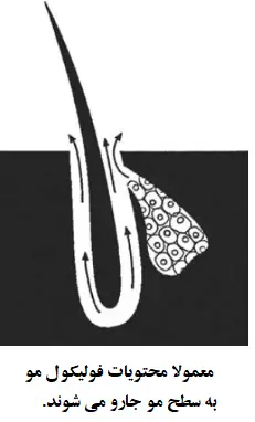 مکانیسم خروج سبوم از فولیکول مو