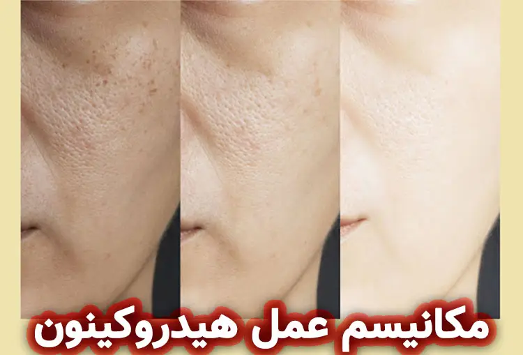 مکانیسم عمل هیدروکینون: چگونه پوست را روشن می‌کند؟