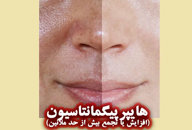 هایپرپیگمانتاسیون (افزایش یا تجمع بیش از حد ملانین)