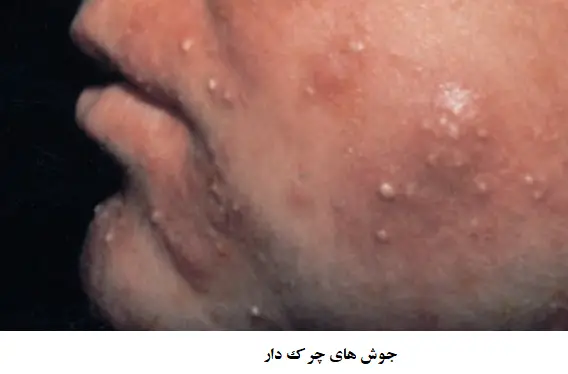 جوش چرک دار