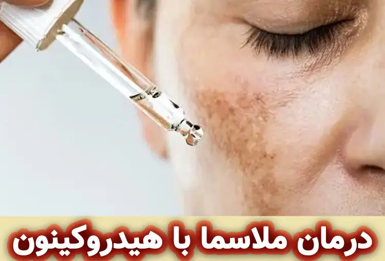 هیدروکینون برای درمان ملاسما