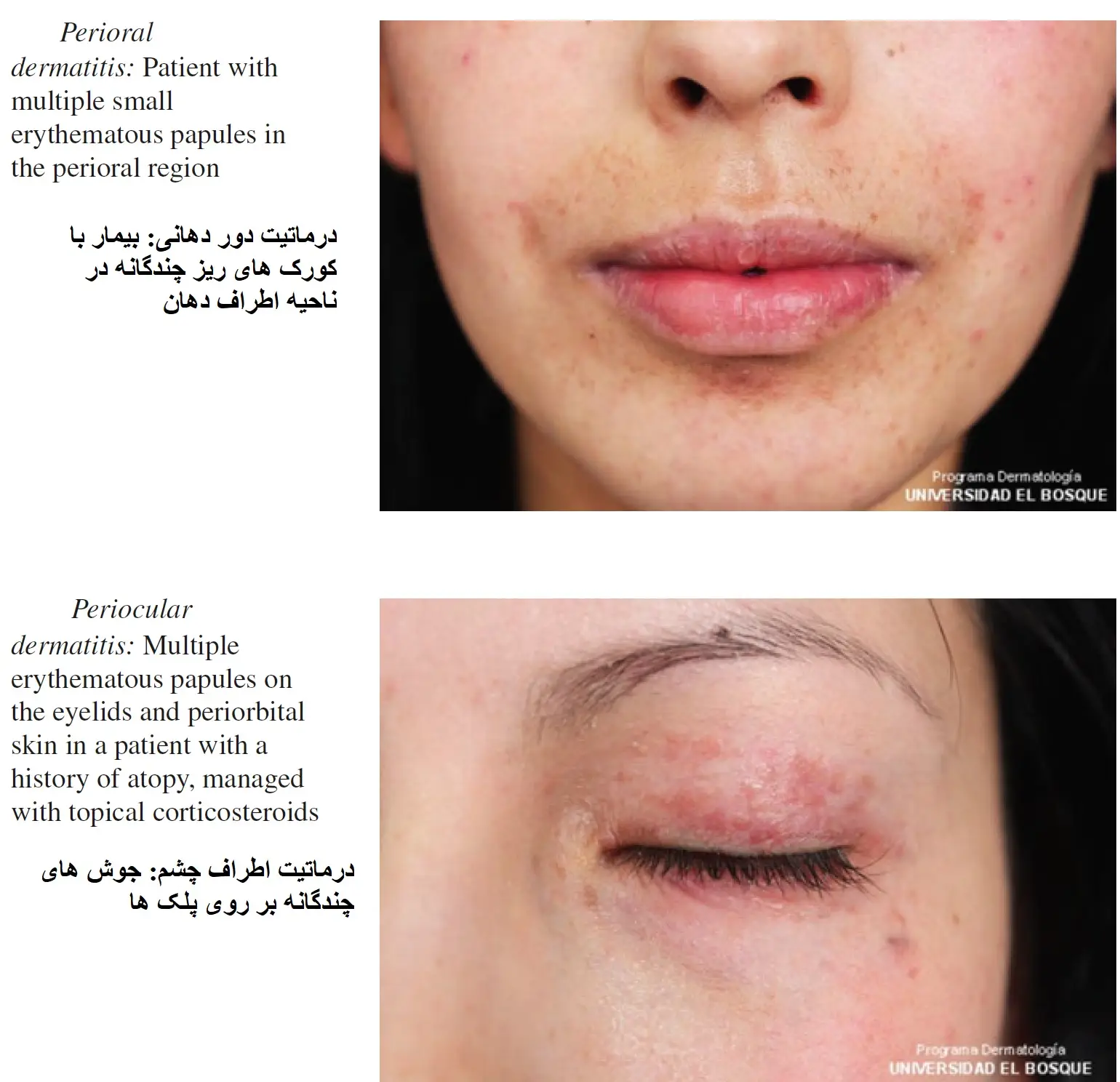 perioral dermatitis