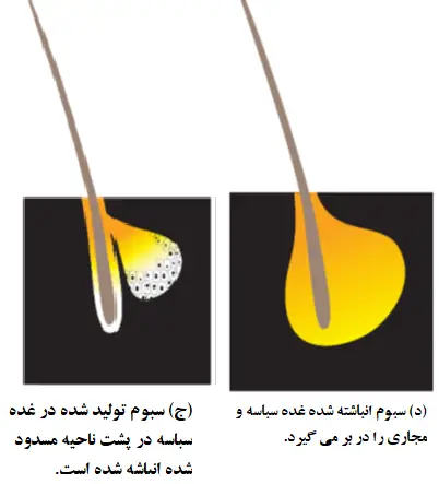 سبوم انباشته شده در فولیکول مو