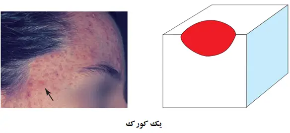 کورک چیست؟