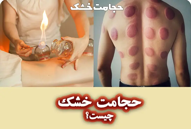 حجامت خشک (بادکش) چیست؟