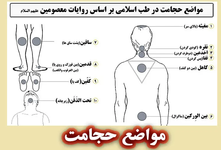 مواضع حجامت عام و موضعی