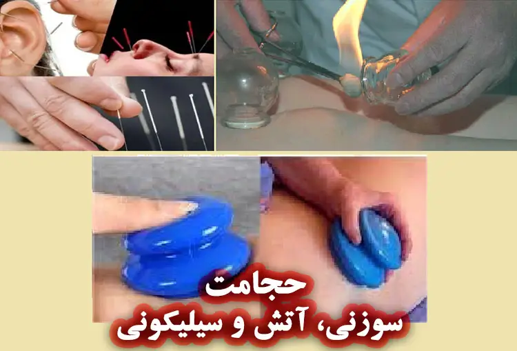 حجامت سوزنی، آتش و سیلیکونی