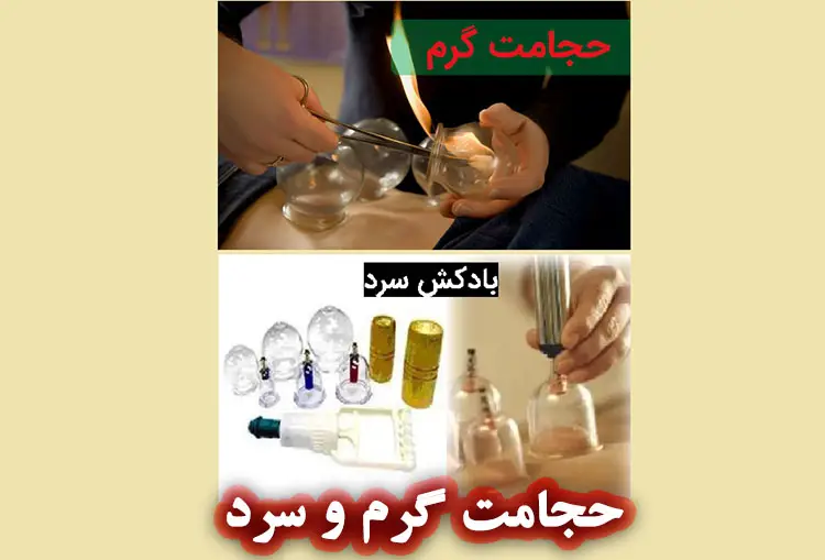 حجامت گرم و سرد چیست؟