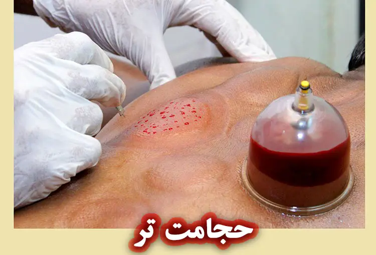 حجامت تر (خونگیری) چیست؟