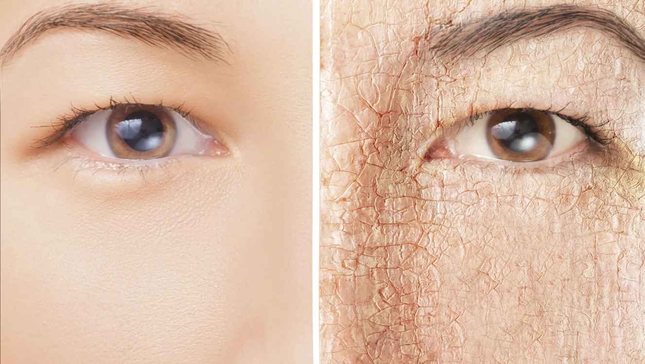 پوست خشک: نشانه های پوست خشک و روش های درمان